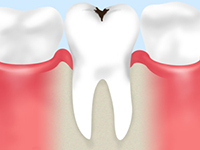 虫歯は「できるだけ削らない」が重要です Before