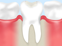 虫歯は「できるだけ削らない」が重要です After