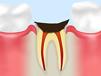 C4歯根の虫歯