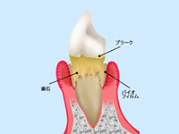 歯周病とは？